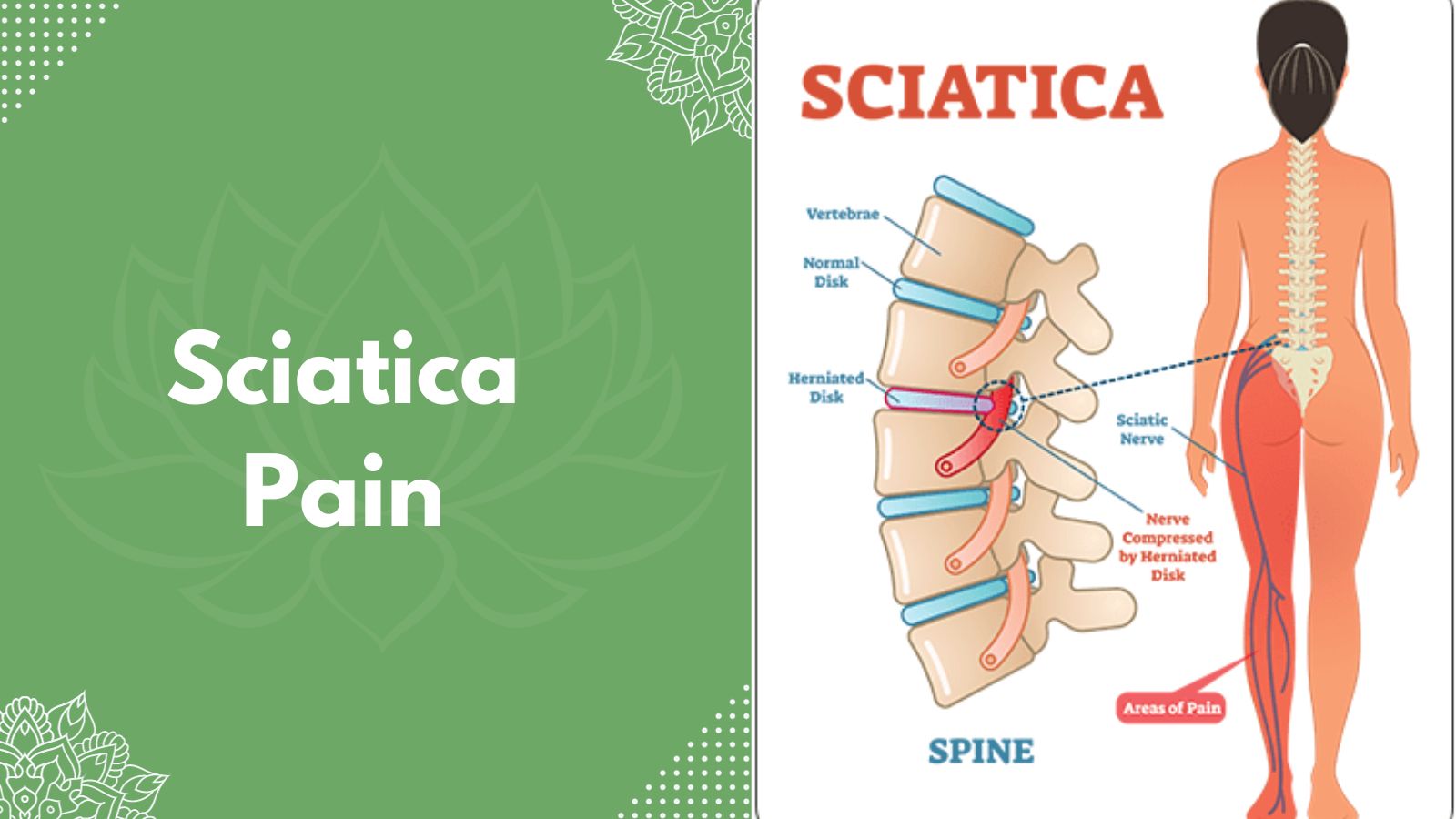 Sciatica Pain